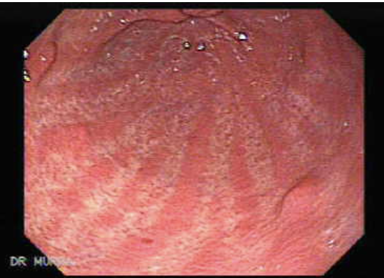 <p>GAVE </p><p>aspect de watermelon à l’endoscopie </p>