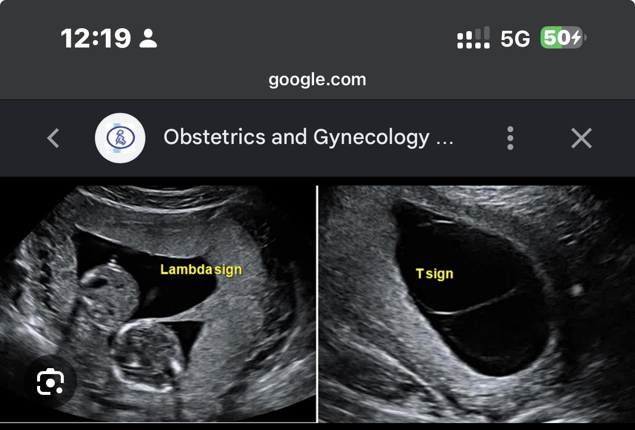 <p>Monochorionic gestation </p>
