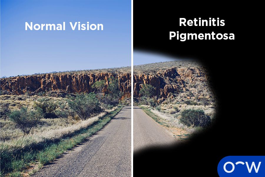 <p>progressive degeneration of the retina (RETINODYSTROPHY). the loss of photoreceptor cells, resulting in symptoms such as night blindness and peripheral vision loss, then central vision loss over time</p>
