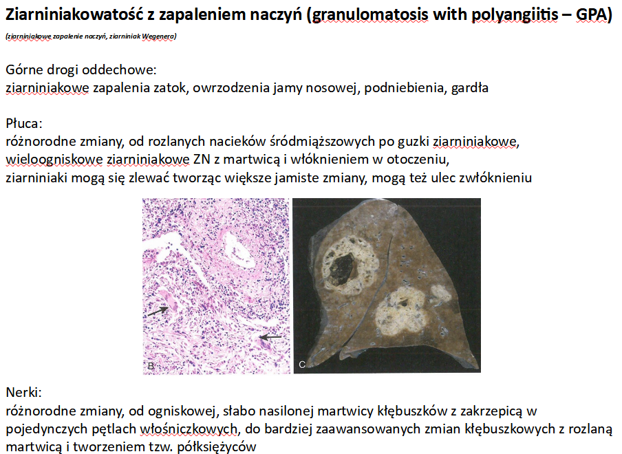 <p>A. martwica włóknikowata</p><p></p><p>b - przewlekle odmiedniczkowe zap. nerek</p><p>e - gruźlica</p>