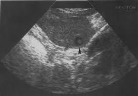 <p>multiple small hypo lesions with echogenic center</p><ul><li><p>bulls eye, target lesions, wheel within wheel </p></li></ul><p></p>