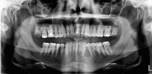 <p>A 43-year-old male patient with a complaint of painless swelling in the left mandibular premolar region. Although the history revealed a presence of the swelling for more than one year without any associated symptoms, the patient preferred to obtain clinical consultation as he was concerned about the swelling. The patient had no previous history of dental treatment except for periodic oral prophylaxis. Provide two differential diagnosis</p>