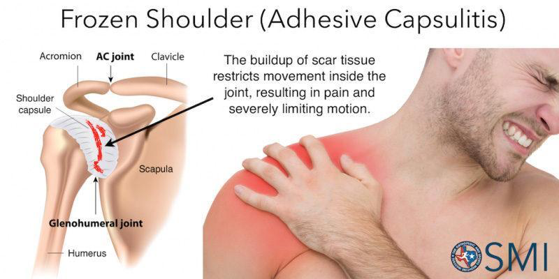 <ul><li><p>Idiopathic (aka it can just happen) chronic synovial inflammation</p></li><li><p>3 stages: Freezing, Frozen, Thawing</p></li><li><p>Too much scar tissue builds up, restricting movement inside the joint. This causes pain and severe limiting of ROM</p></li></ul><p></p>