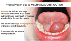 <p>- Large retention cysts in the ducts of submandibular, sublingual, or mucous glands of the floor of the mouth</p><p>- Lesions are large, blue-purple-pink with pronounced vascularity</p><p>- Treatment is by excision or marsupialization</p>