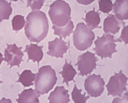 <p><span style="background-color: transparent;"><strong>&nbsp;Acanthocytes (Spur cells / Thorn cells)</strong></span></p>