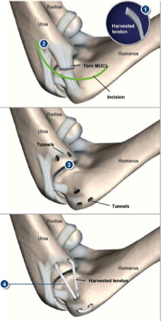 <p>Tommy John Surgery<br>-what are the factors before doing the surgery </p>