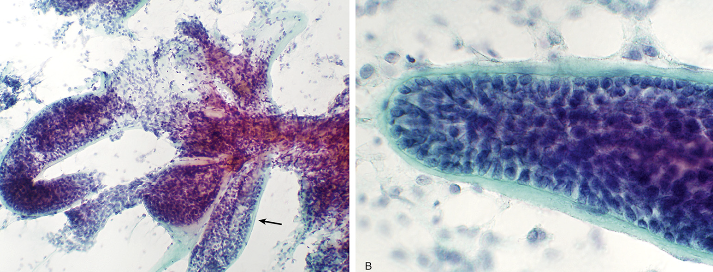 <p>Cytologie parotide </p><p>1) Catégorie selon Milan</p><p>2) Diagnostic</p><p>3) pourquoi cette catégorie</p>