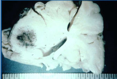 <p>In life, this cow had acute onset blindness, paralysis, tonic-clonic seizures and anorexia with depression. Post mortem shows CNS vasculitis, infarction, and abscess formation. What happened and what are other differentials?</p>