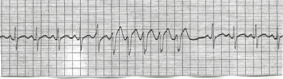 <p>What does this EKG show?</p>