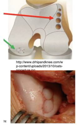 <p></p><ul><li><p>"Fill in the dot"</p></li><li><p>Take and harvest chondral / bone plugs from low demand areas (e.g., on top of femoral condyles)</p></li><li><p>These plugs are then placed in the lesioned area</p></li></ul><p></p>