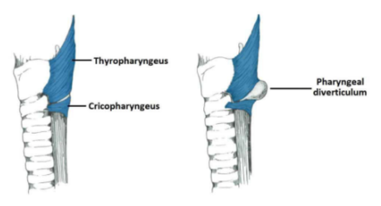 <p>also called the Zenker's diverticulum</p><p>may be caused by a <span>failure of the cricopharyngeus muscle → increase pressure → pouch</span></p><p>Usually found in older adults</p><p>Do a barium study to test</p>