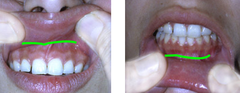 <p>Digital palpation to feel for exostoses, abscesses, etc.</p>