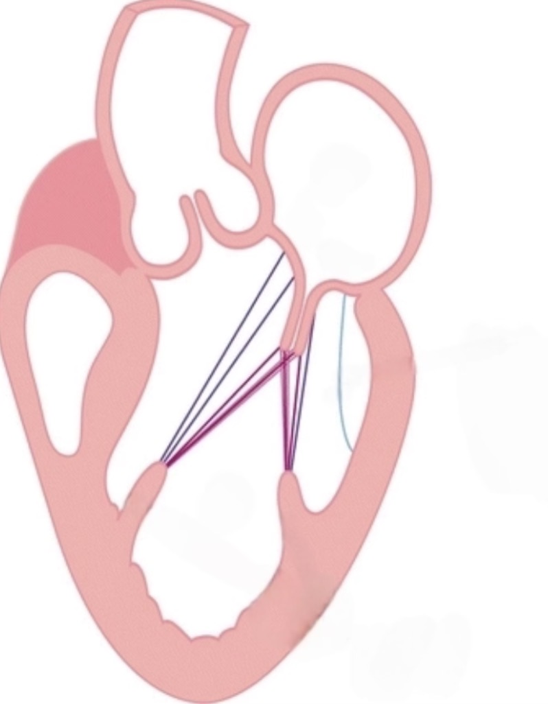 <p>Fibrous heart strings anchoring AV valve flaps to papillary muscles</p>