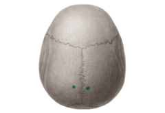 <p>parietal foramen</p>