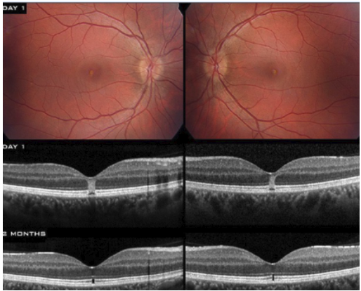 <ul><li><p>Causes color change on fundus due to damaged PRs that contain carotenoids</p></li><li><p>RPE usually no damaged</p></li></ul><p></p>