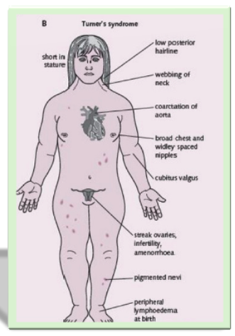 <p>• An absence of all or part of the X chromosome.</p><p>• Characteristically, the female is short in stature, but her body proportions are normal.</p><p>• Variations in syndrome with abnormalities</p>