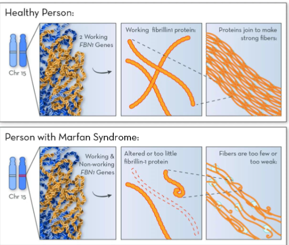 <p>Marfan Syndrome</p>