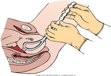 <p>forceps assisted vaginal delivery</p>