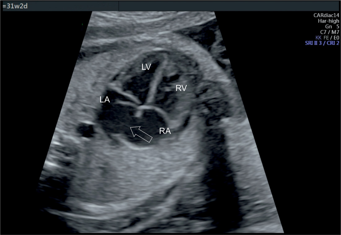 <p>Atrial septal defect ASD</p>