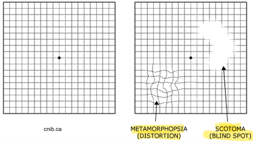 <p></p><p>Monocular! </p><p>Ask the patient to always fixate on the<strong> central black dot</strong></p><ol><li><p>is the central dot clear and single? </p></li><li><p>Can you see all 4 corners of the larger square? </p></li><li><p>Are any of the vertical/horizontal lines missing, wavy or distorted? </p></li><li><p>Are there any black or missing patches? </p></li></ol><p>Repeat for the other eye!</p><p></p>