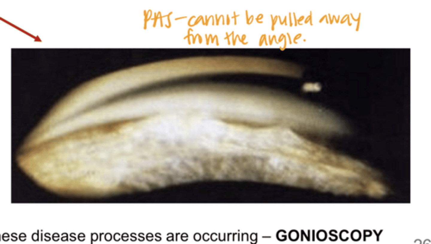 <p>Peripheral Anterior Synechiae -- Cannot be Pulled Away from the Angle (Pic)</p>