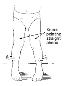 <p>Tibial torsion </p>