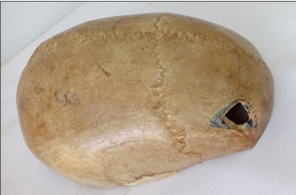<p>Questions</p><ol><li><p>What is the specimen being examined?</p></li><li><p>What are the type, specific descriptive features, and dimensions of the fracture?</p></li><li><p>What type of causative instrument and cross-sectional shape produce this injury?</p></li><li><p>How is the time of death estimated?</p></li><li><p>What are the possible causes of death?</p></li><li><p>What is the final diagnosis for this specimen?</p></li></ol><div data-type="horizontalRule"><hr></div><p></p>