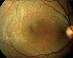 <p>Macular "spoke-wheel" pattern caused by splitting (schisis) of the retinal layers.</p>