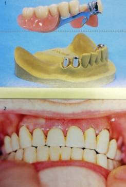 <ul><li><p>consist of inner and outer telescope or primary/secondary </p></li><li><p>firmly attached to one another caps</p></li><li><p>can’t be prefabricated</p></li><li><p>can be made cylindrical or conical</p></li></ul><p></p>