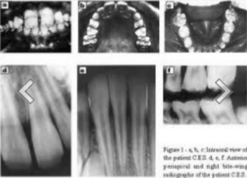<p><span>Radiographic features: Affected enamel exhibits radiodensity similar to dentin</span></p>