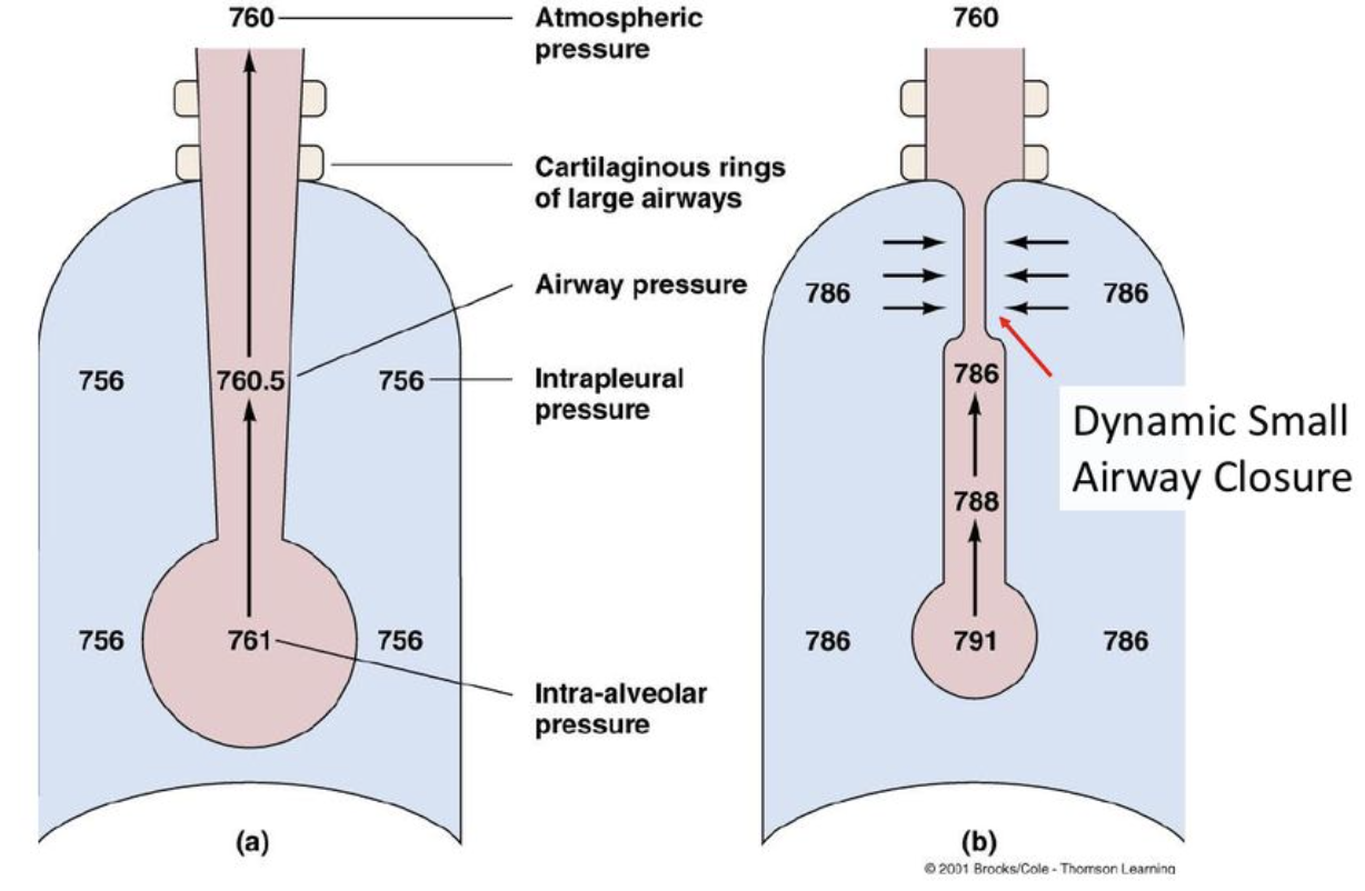<p>At the point in the small airway where airway pressure drops below the surrounding intrapleural pressure, the higher external pressure physically pinches it shut. </p><p>This traps remaining air proximal to the closure point, and that trapped air becomes part of the residual volume. </p><ul><li><p>This is a normal, healthy mechanism</p></li><li><p>no one can fully empty their lungs </p></li></ul><p></p>