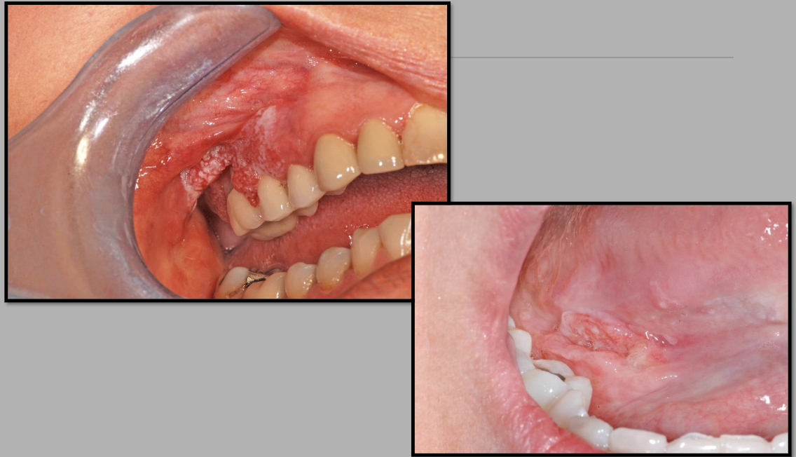 <p>rolled borders - bad in the dental cavity</p>