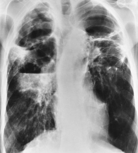 <p>Lung disease caused by bacteria and spreads via droplets in the air; no longer prevalent in the US</p><ul><li><p>Latent and Active</p></li></ul><p></p>