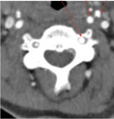 <p><span>椎动脉</span></p>