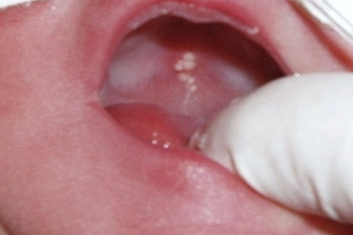<p>Cyst of Newborn: occurs along the median palatal raphe; due to epithelial entrapment by palatal fusion </p>