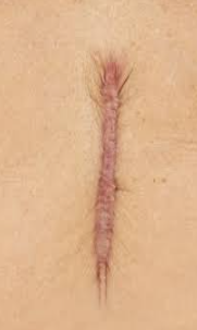 <p>What type of scar is this?</p>