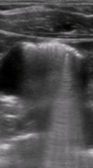 <p><span style="background-color: transparent;">Caused by refracting properties of gas bubbles or impedance of gas</span></p>