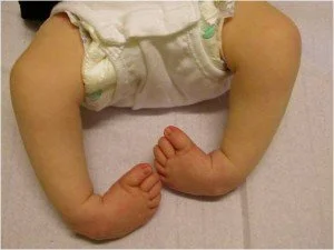 <p>foot inversion</p>