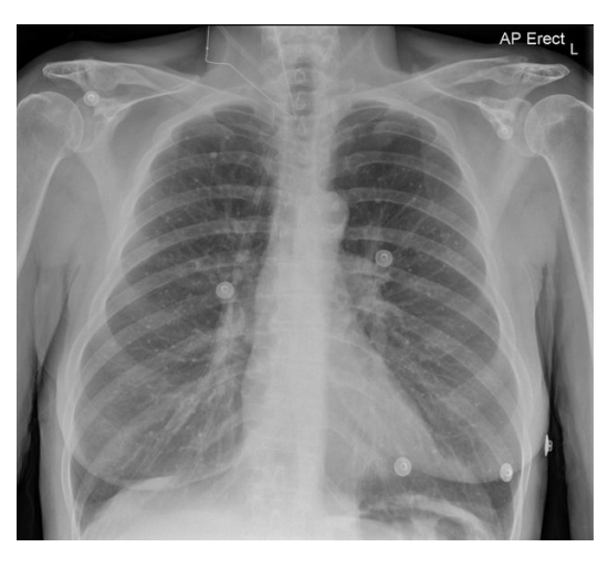 <p>Multiple small, round calcific lung lesions </p>