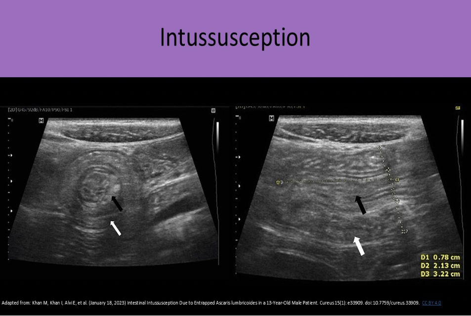 <p>B. prominent focal area of concentric rings of bowel</p><p>An intussusception refers to a segment of bowel that involutes into itself. You will see a focal area of concentric rings of bowel that do not persitalse or change shape.</p>