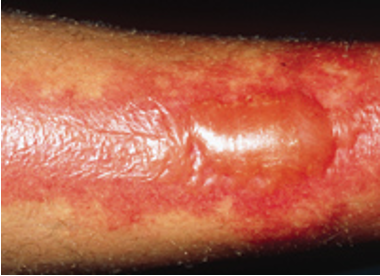 <p>blisters, exposed dermis is red/moist; very painful</p>
