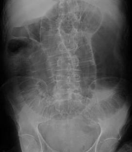 <p>Que signo radiologico observa en la siguiente imagen </p>