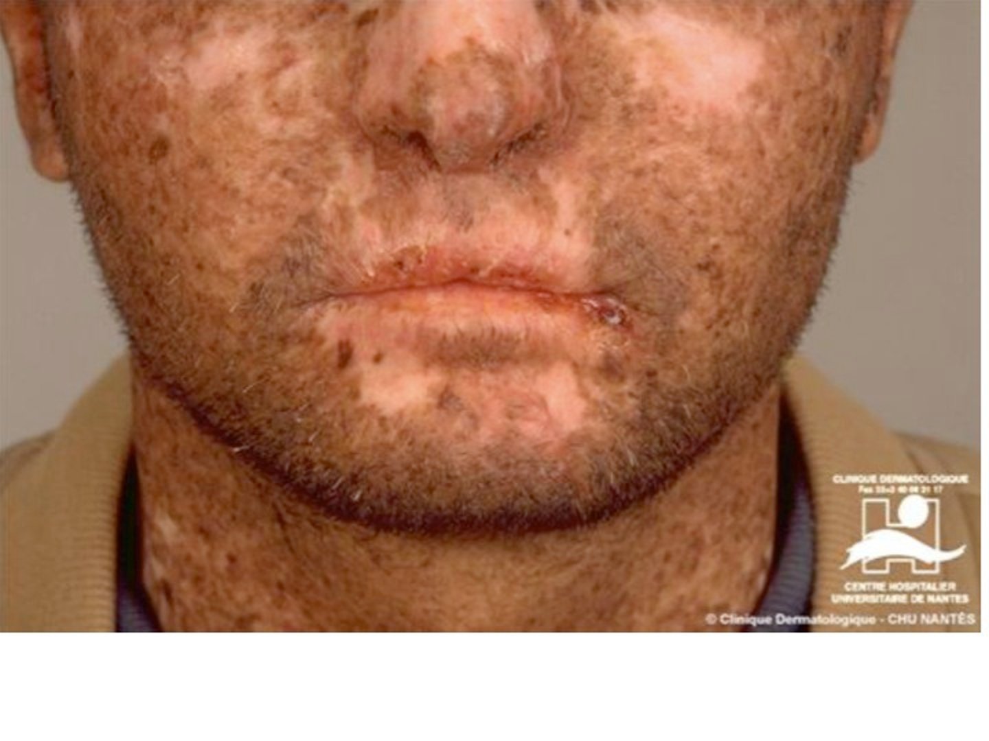 <p>abnormally dry skin</p>