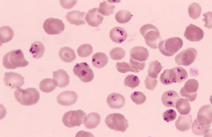 <p>What disease is this patient infected with?</p>