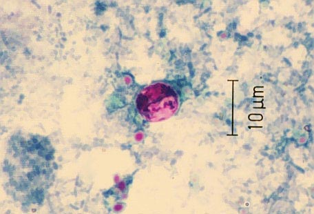 <p>Acid fast they appear light pink to deep red/purple and 8-10um, contain immature sporoblast (bigger than crypto).<u> Cyclospora oocysts are auto fluorescent</u></p>