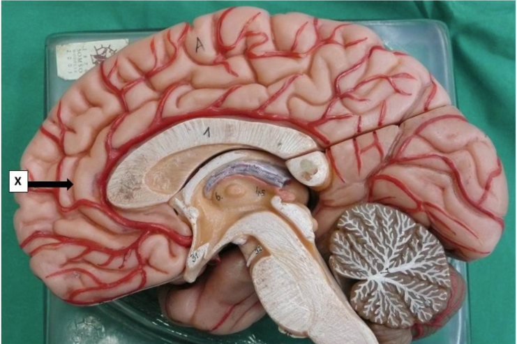 <p>Which one statement is true concerning structure X?</p><p>This is the corpus callosum</p><p>This is the cingulate sulcus</p><p>This is the calcarine sulcus</p><p>This is the cingulate gyrus</p><p>This is the parieto-occipital sulcus</p>