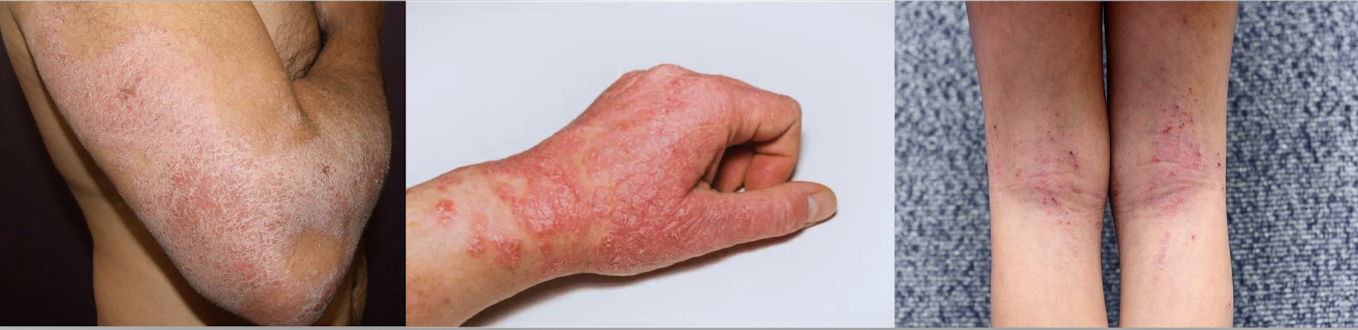 <p>reaction to the skin most often r/t type 1 hypersensitivity immune responseâ chronic, relapse disease, skin response to environmental allergens, associated with asthma and allergic rhinitis </p><p>symptoms: acuteâredness, oozing vesicles, extreme itching; subacuteâscaly, light red to red-brown plaques, itching; chronicâthickened, dry skin with lichenification, possible hypo/hyper-pigmentation </p><p>treatment: topical immunodulators, moisturize dry skin, stress reduction; antibiotics for secondary; severe inflammation and itchingâ steroids, phototherapy</p>