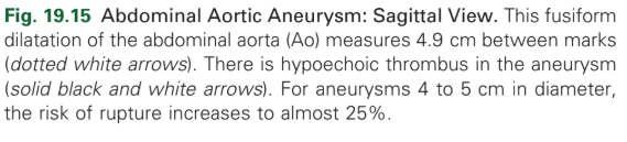 <p>Abdominal Aortic Aneurysm</p>
