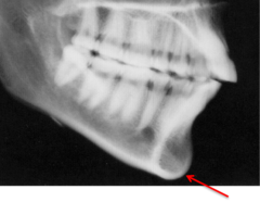 <p>which anatomical landmark:</p><p>- Midpoint between the most anterior and inferior point on the boney chin</p>