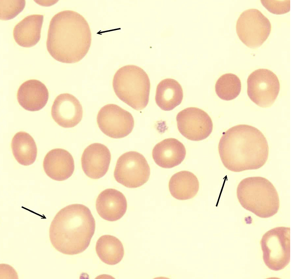 <p>What kind of RBC is >12 microns?</p>